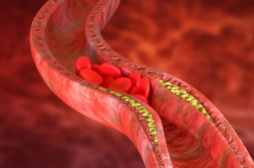15 Healthy Eating Tips to Manage Blood Cholesterol excess blood cholesterol can be reduced by avoiding foods with trans fats, limiting the consumption of saturated fats and replace with unsaturated fats.