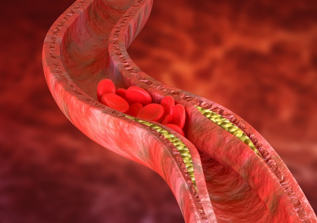 Thickening of blood vessel walls due to the deposition of cholesterol