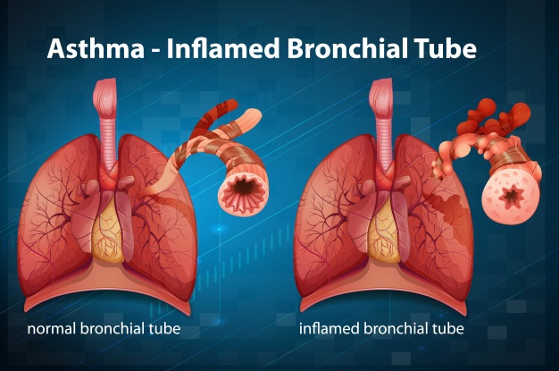 Asthma prevention stratergies