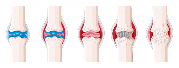 The progression and effect of  rheumatoid arthritis on joints of the body